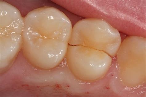 Cracked Tooth | American College of Prosthodontists