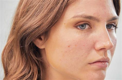 Uneven & Blotchy Skin: Causes & Treatments | The Bar