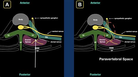 erector spinae plane block Fig2 - ACEP Now