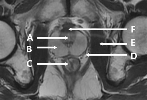 Axial T2 weighted magnetic resonance imaging of the male pelvis | The BMJ