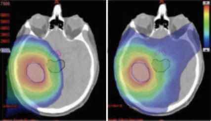 Proton Therapy Brain Tumor - All About Radiation