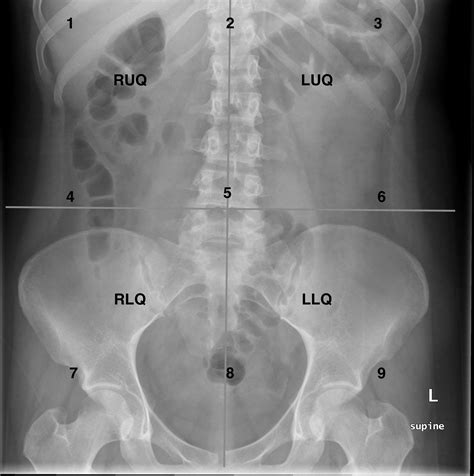 Approach to the Abdominal X-ray (AXR) – Undergraduate Diagnostic ...