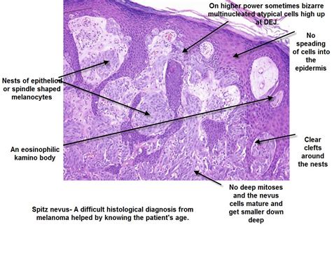 Dermoscopy Made Simple: Spitz Nevus