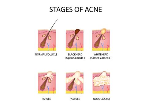 Stages of acne by Tigatelu on Dribbble