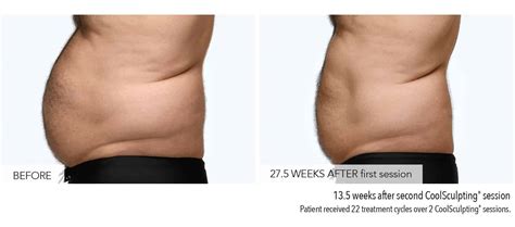 CoolSculpting for Men Near Me | CoolSculpting Stomach | Male ...