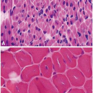 Histological findings of muscle biopsy. (A) Muscle biopsy from patient ...