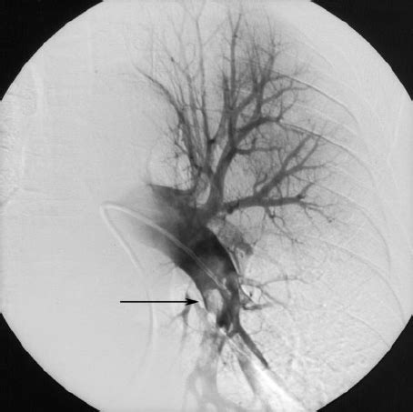 Pulmonary angiogram (digital subtraction angiography) revealing large... | Download Scientific ...