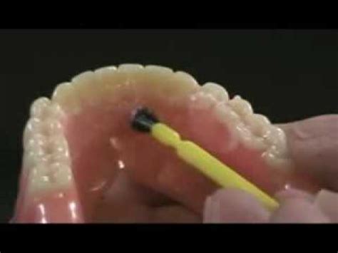 Denture Repair - YouTube