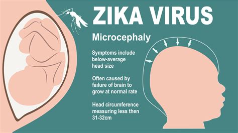 Zika and Pregnancy: Symptoms, Effects and Prevention