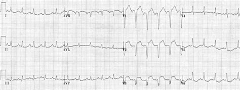 Left Bundle Branch Block (LBBB) • LITFL • ECG Library Diagnosis