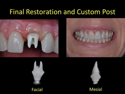 Single Anterior Implants Made Easy As 1-2-3 - Spear Education