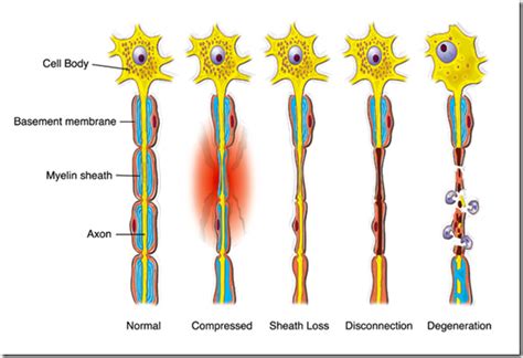 What is Neuropraxia - Definition, Symptoms, Causes, Treatment - Health ...