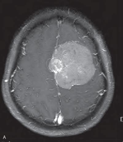 Preoperative embolization versus no embolization for WHO grade I intracranial meningioma ...