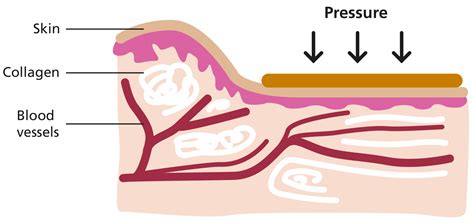 Pressure garments - Resource Library - Sheffield Children's NHS ...