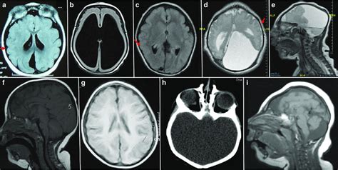 Representative magnetic resonance images (MRI) for the cases with... | Download Scientific Diagram