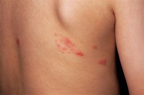 Shingles Rash Photograph by Dr P. Marazzi/science Photo Library