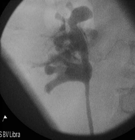 Retrograde pyelogram illustrating a healed ureter on a re-look in 6 ...