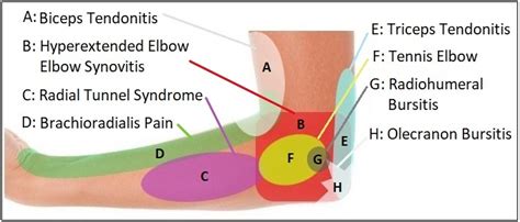 Elbow Pain Diagram: Diagnosis Chart