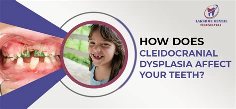 How Does Cleidocranial Dysplasia Affect Your Teeth?