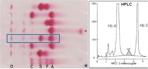 Microangiopathy Sickle Cell Lab