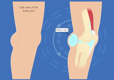 Understanding Pain Behind the Knee: Causes and Diagnosis - Sport Doctor ...