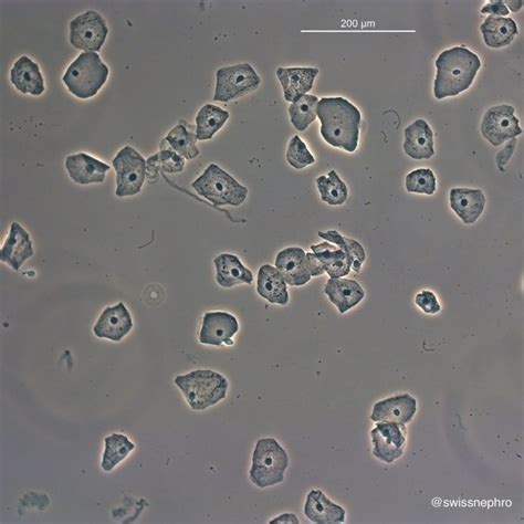 Urine Sediment of the Month: 4 Flavors of Nucleated Cells - Renal Fellow Network