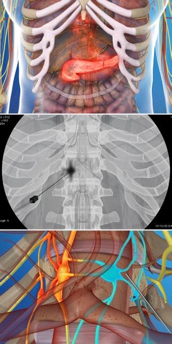 Celiac Plexus Block - Pain Specialists of Southern Oregon