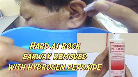 Hard as Rock Earwax Removal using Hydrogen Peroxide - YouTube