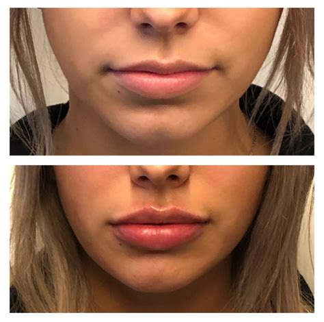 Lip Filler to Correct Asymmetry | Boss Gal Beauty Bar