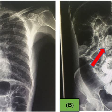 (A) Normal chest X‐ray, (B) Abdominal x‐ray showed fecal impaction in... | Download Scientific ...