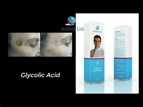 Seborrheic keratosis Removal using XanthRemover 70% Glycolic Acid Peel ...