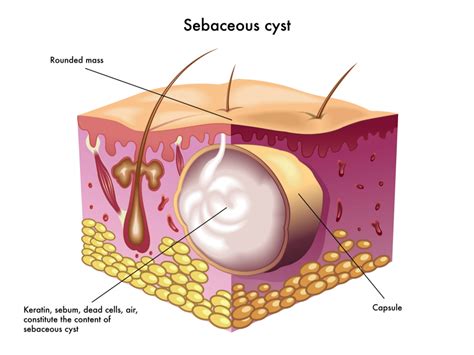 Cysts: What Are the Most Common Types of Cysts & How to Treat Them ...