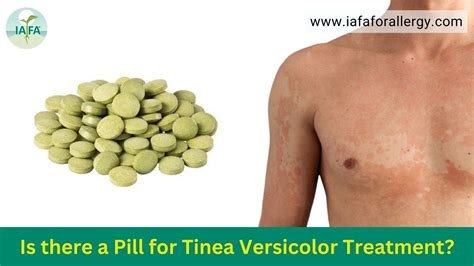 Is there a Pill for Tinea Versicolor Treatment?