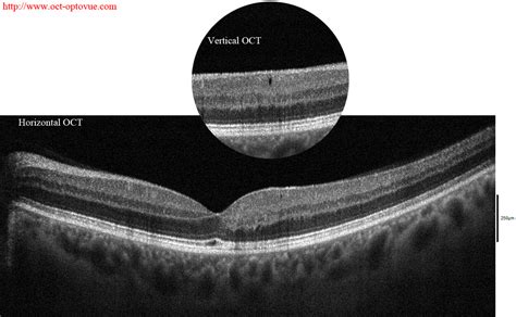 OCT angiography & macular telangiectasia