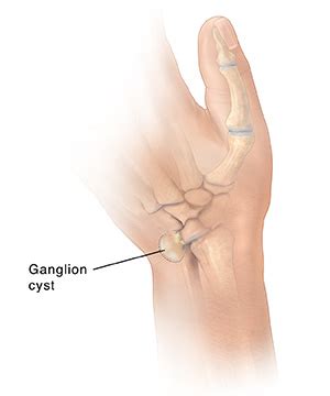 Ganglion Cyst | Saint Luke's Health System