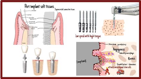 Dental Implants | How an implant attaches to bone | Osseointegration of dental implants - Dental ...