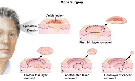 Mohs Case Before & After - Infiltrative Basal Cell Carcinoma