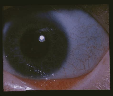 Osteogenesis imperfecta; Fragilitas Ossium; Lobstein Disease