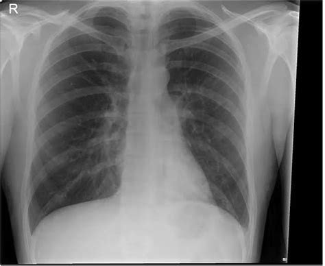 Rare extrapulmonary complications of Mycoplasma pneumoniae infection ...