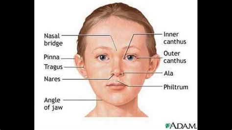 Down disease or Down's syndrome bệnh down.Congenital abnormally in children - YouTube