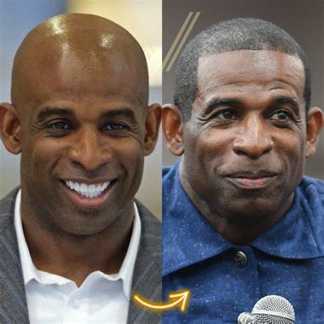 Deion Sanders' Hair Transplant: Before and After Transformation