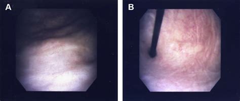 At 6 months following cystoscopy with fulguration of trigonitis (A), of... | Download Scientific ...