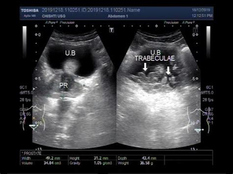 Ultrasound Video showing Urinary retention with enlarged prostate and ...