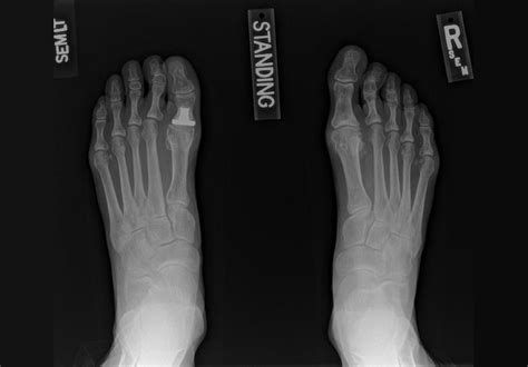 Salvage surgery for failed toe joint replacement - Mayo Clinic