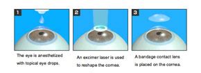 Difference Between LASIK and PRK | Richmond, Virginia | Lipstock LASIK