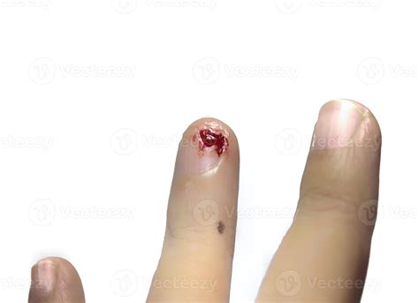 bleeding wound on finger at left hand with white background, bleeding ...