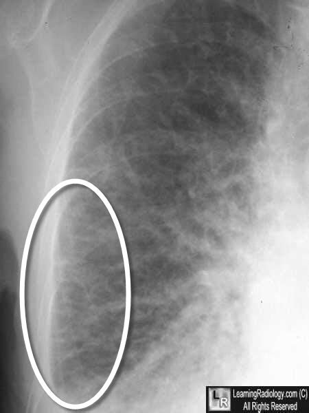 Learning Radiology - Congestive Heart Failure, Pulmonary Edema