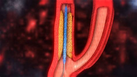 Carotid Artery Stenting video - YouTube