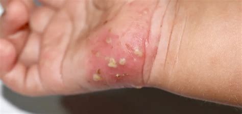 Feel the Crawl: Scabies on Your Skin