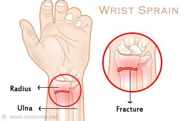 Wrist Sprain - Causes, Symptoms, Diagnosis, Treatment